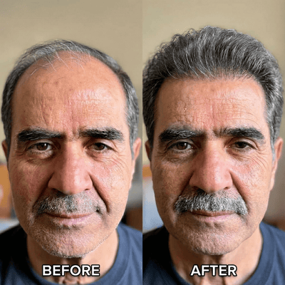 SvenLabs™ Hair Regrowth Protocol