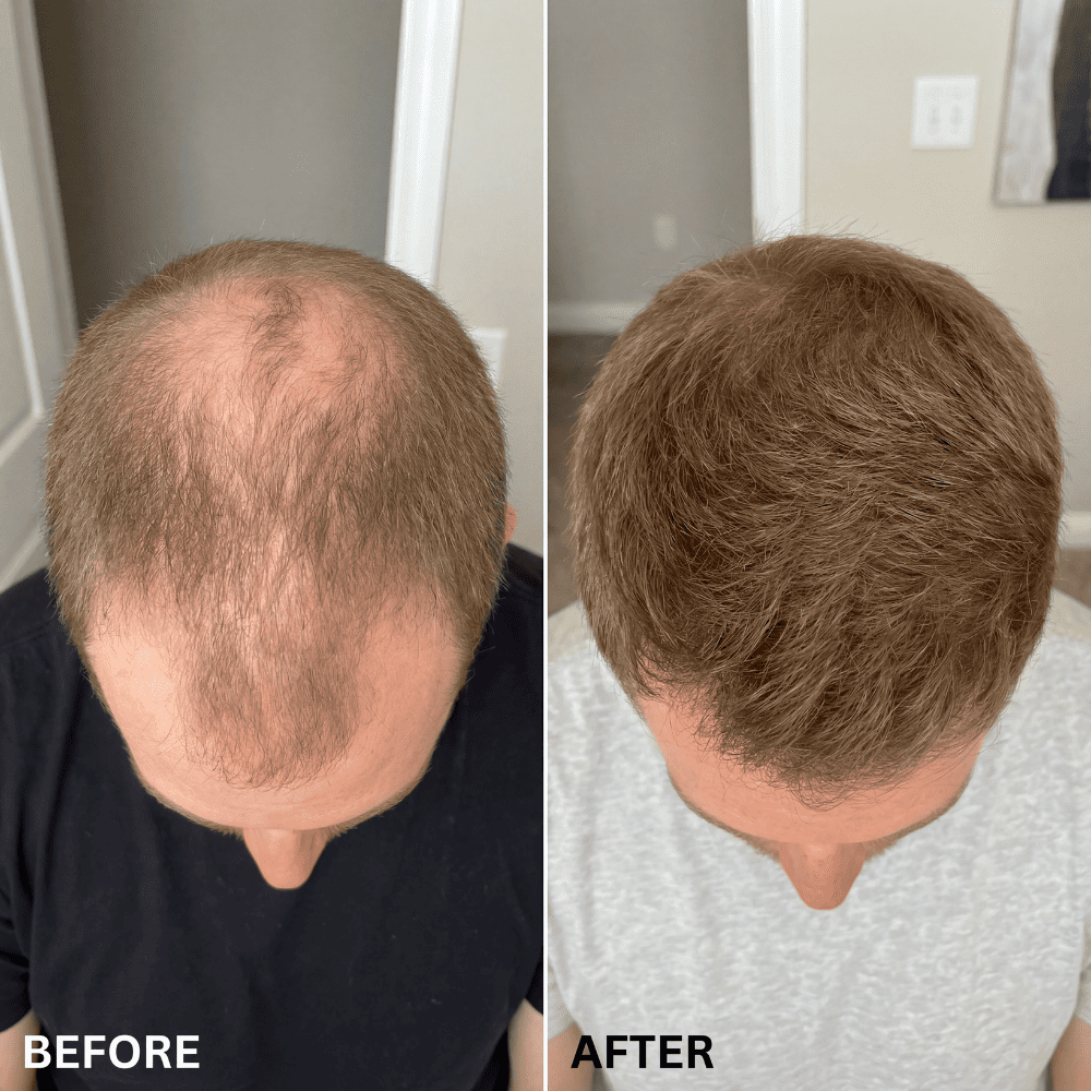 SvenLabs™ Hair Regrowth Protocol