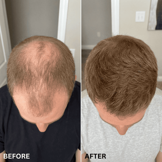 SvenLabs™ Hair Regrowth Protocol