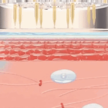 How Microneedling Works